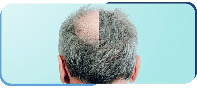 PRF Hair Restoration Treatment Clinic Near Me in Madison, MS