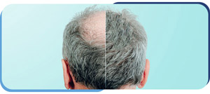 PRF Hair Restoration Treatment Clinic Near Me in Madison, MS